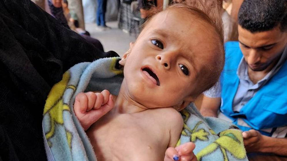 অপুষ্টিতে আক্রান্ত গাজায় ছয় মাস বয়সি শিশু সালাম। ছবি: সংগৃহীত